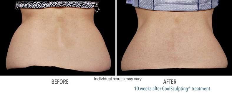 coolsculpting-before-and-after-cool-sculpting-phoenix