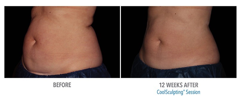 coolsculpting-phoenix