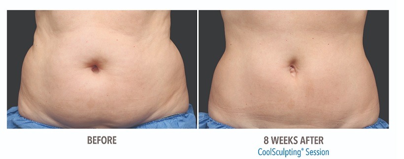 coolsculpting